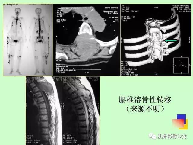 【PPT】骨骼肌肉系统疾病MRI诊断基础