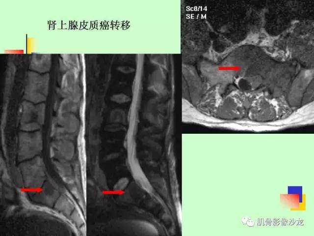 【PPT】骨骼肌肉系统疾病MRI诊断基础