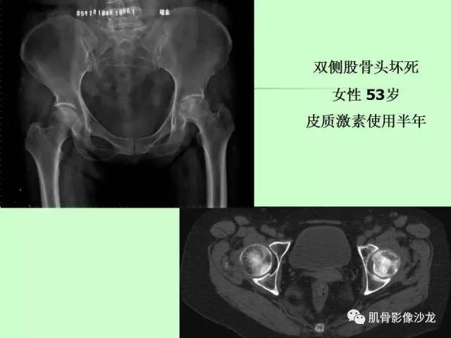 【PPT】骨骼肌肉系统疾病MRI诊断基础