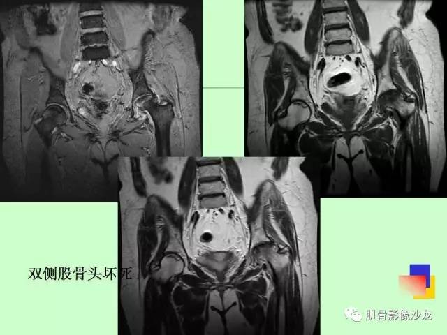 【PPT】骨骼肌肉系统疾病MRI诊断基础