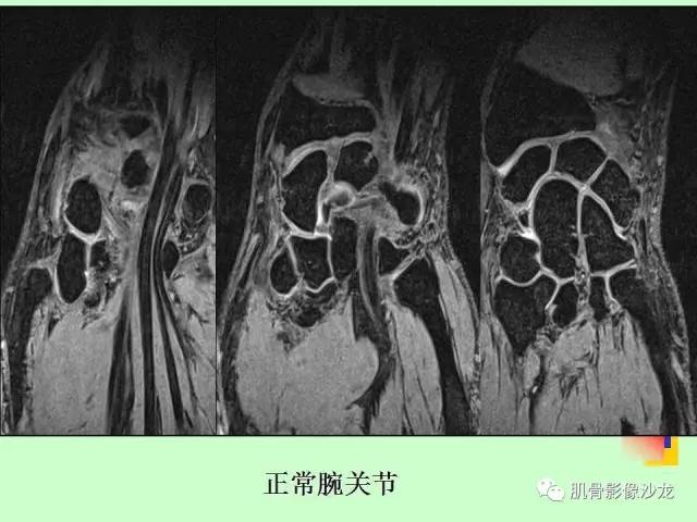 【PPT】骨骼肌肉系统疾病MRI诊断基础