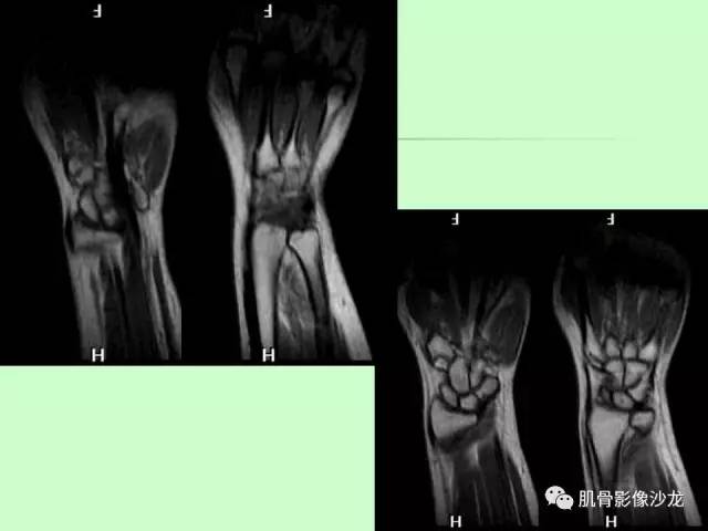 【PPT】骨骼肌肉系统疾病MRI诊断基础