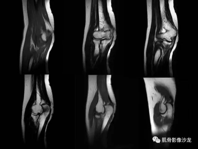 【PPT】骨骼肌肉系统疾病MRI诊断基础