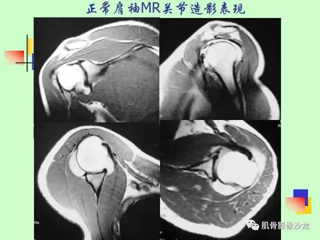 【PPT】骨骼肌肉系统疾病MRI诊断基础