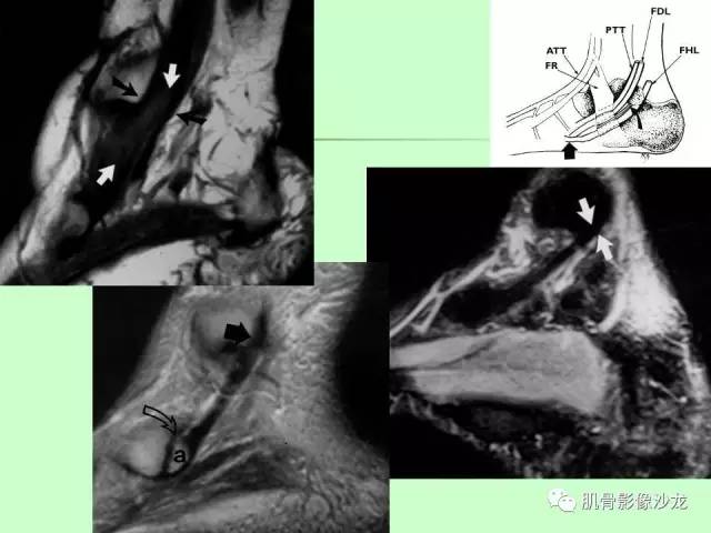 【PPT】骨骼肌肉系统疾病MRI诊断基础
