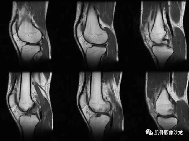 【PPT】骨骼肌肉系统疾病MRI诊断基础