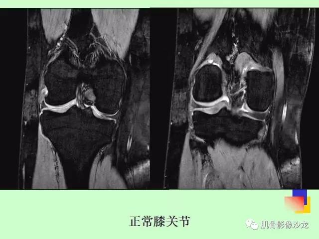 【PPT】骨骼肌肉系统疾病MRI诊断基础