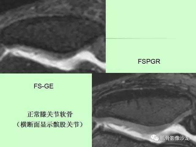 【PPT】骨骼肌肉系统疾病MRI诊断基础