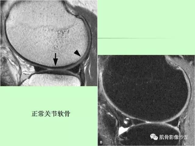 【PPT】骨骼肌肉系统疾病MRI诊断基础