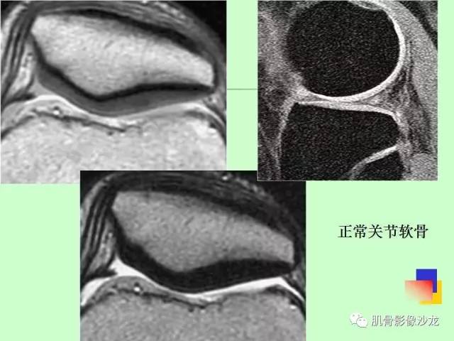 【PPT】骨骼肌肉系统疾病MRI诊断基础