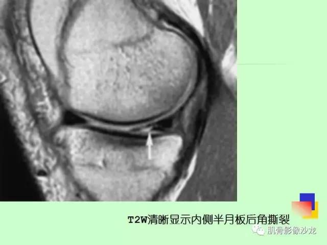 【PPT】骨骼肌肉系统疾病MRI诊断基础