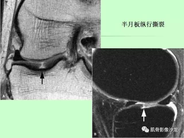【PPT】骨骼肌肉系统疾病MRI诊断基础