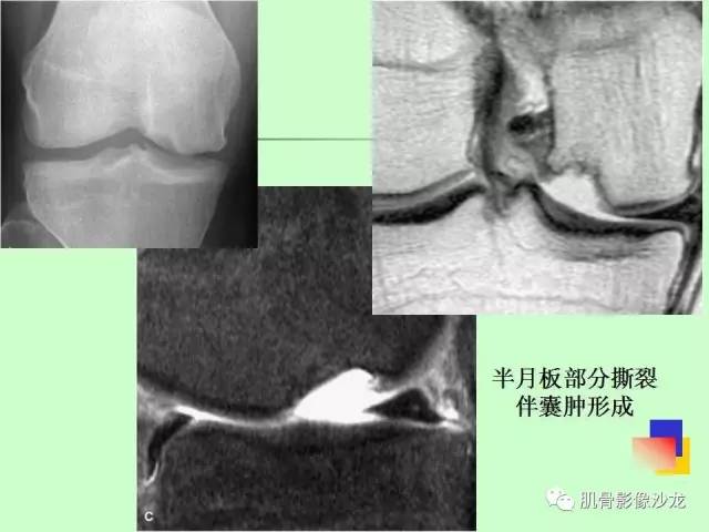 【PPT】骨骼肌肉系统疾病MRI诊断基础