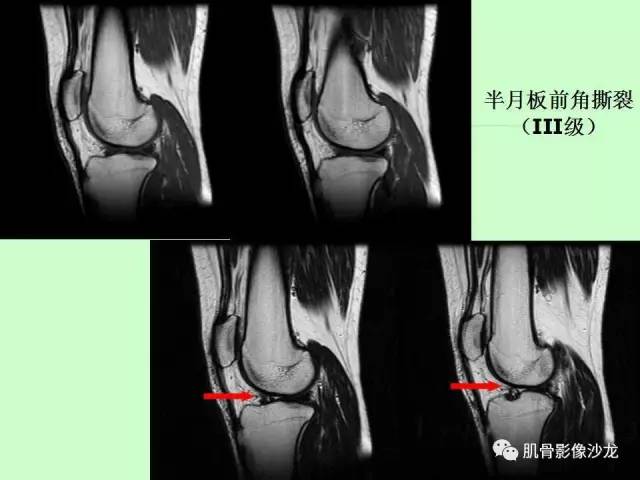 【PPT】骨骼肌肉系统疾病MRI诊断基础