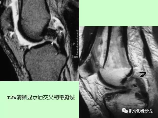 【PPT】骨骼肌肉系统疾病MRI诊断基础