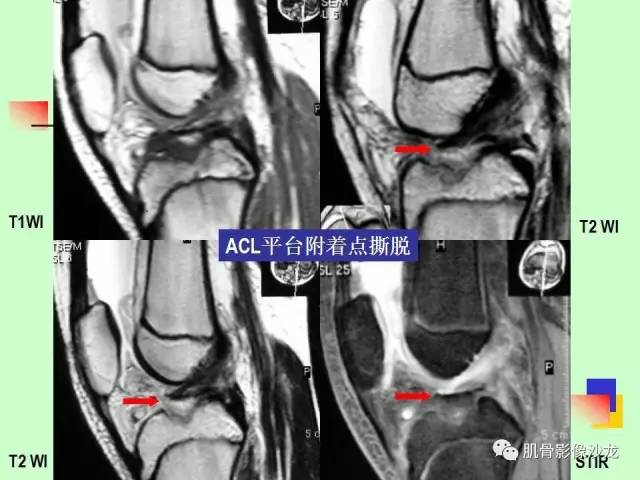 【PPT】骨骼肌肉系统疾病MRI诊断基础