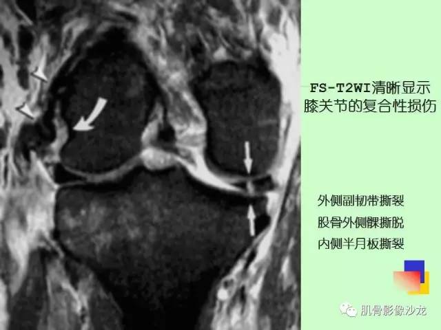 【PPT】骨骼肌肉系统疾病MRI诊断基础
