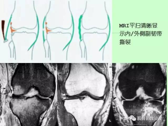 【PPT】骨骼肌肉系统疾病MRI诊断基础