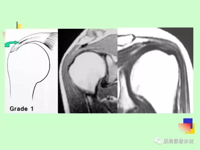 【PPT】骨骼肌肉系统疾病MRI诊断基础