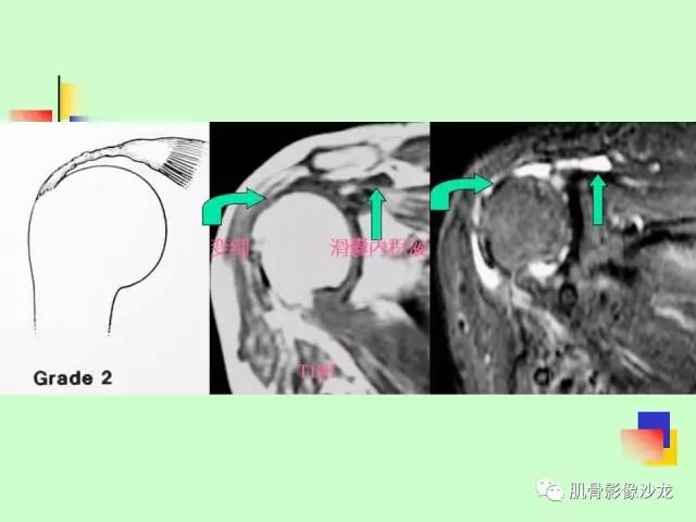 【PPT】骨骼肌肉系统疾病MRI诊断基础