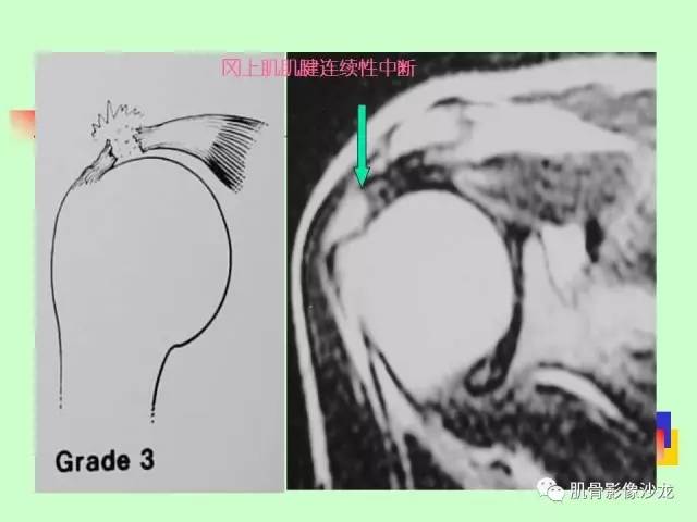 【PPT】骨骼肌肉系统疾病MRI诊断基础