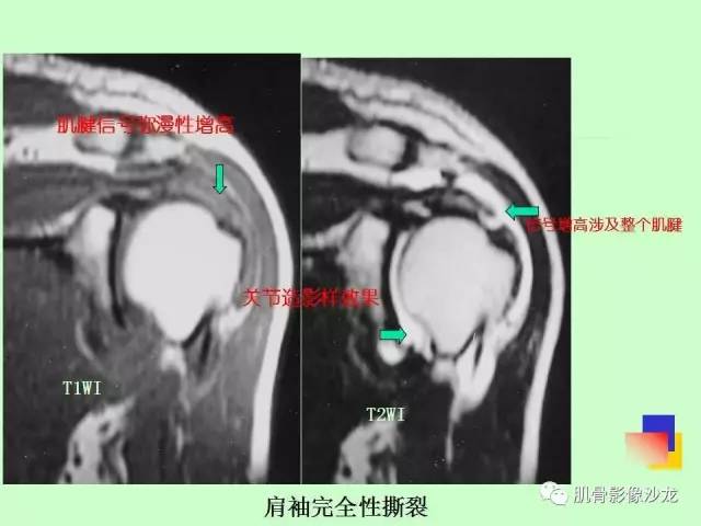 【PPT】骨骼肌肉系统疾病MRI诊断基础