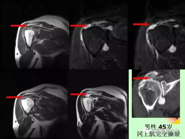 【PPT】骨骼肌肉系统疾病MRI诊断基础