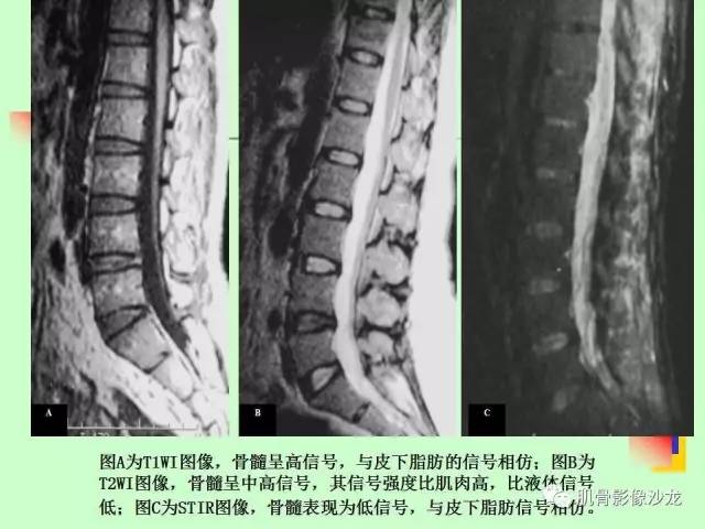 【PPT】骨骼肌肉系统疾病MRI诊断基础