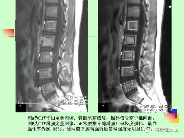【PPT】骨骼肌肉系统疾病MRI诊断基础