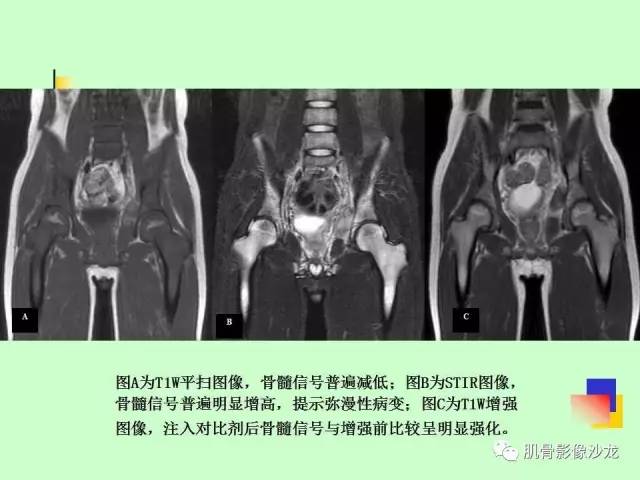 【PPT】骨骼肌肉系统疾病MRI诊断基础