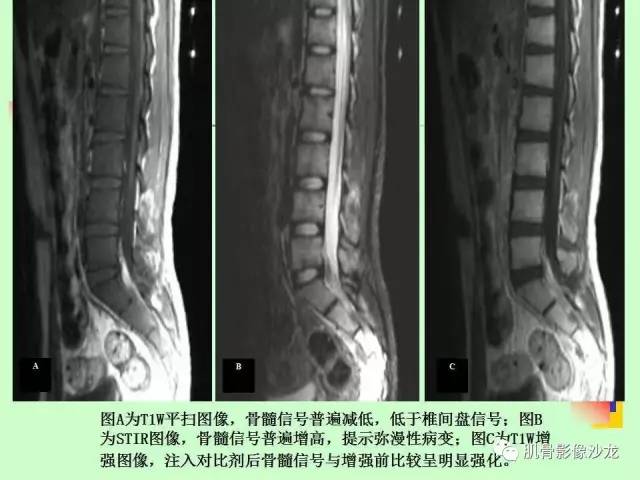 【PPT】骨骼肌肉系统疾病MRI诊断基础