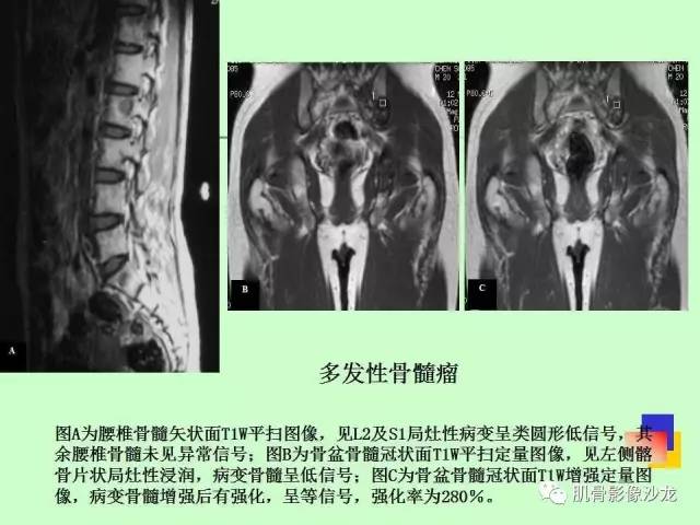 【PPT】骨骼肌肉系统疾病MRI诊断基础