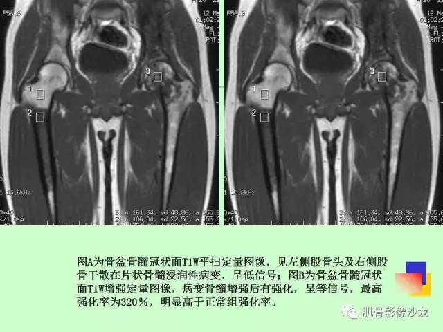 【PPT】骨骼肌肉系统疾病MRI诊断基础