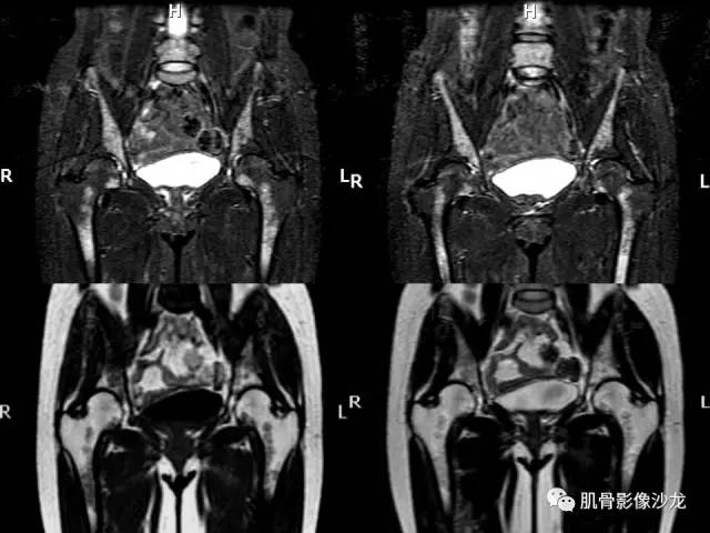【PPT】骨骼肌肉系统疾病MRI诊断基础