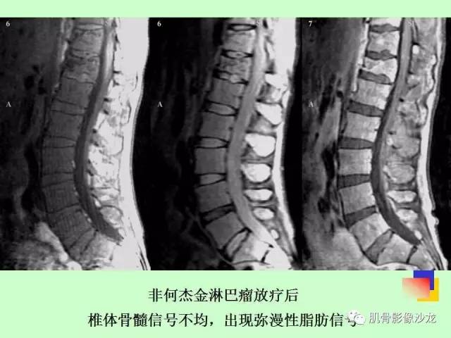 【PPT】骨骼肌肉系统疾病MRI诊断基础