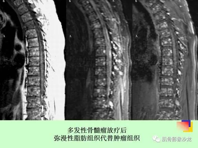 【PPT】骨骼肌肉系统疾病MRI诊断基础