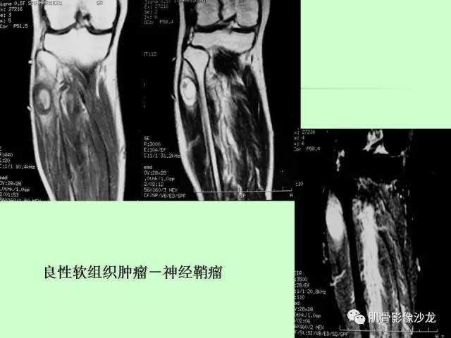 【PPT】骨骼肌肉系统疾病MRI诊断基础