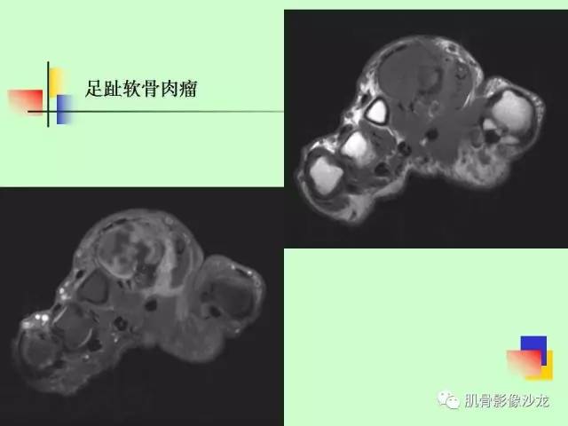 【PPT】骨骼肌肉系统疾病MRI诊断基础