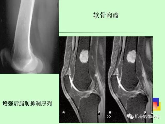 【PPT】骨骼肌肉系统疾病MRI诊断基础
