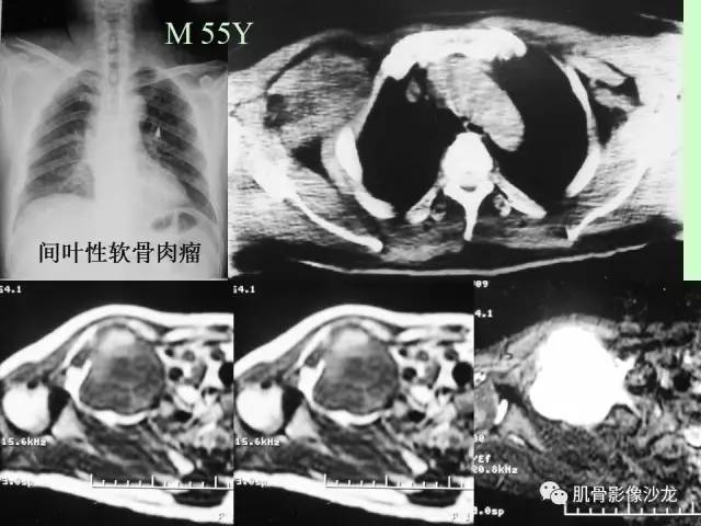 【PPT】骨骼肌肉系统疾病MRI诊断基础