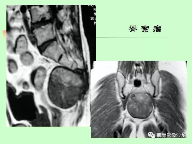 【PPT】骨骼肌肉系统疾病MRI诊断基础