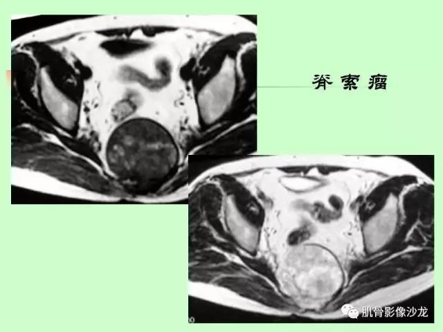【PPT】骨骼肌肉系统疾病MRI诊断基础