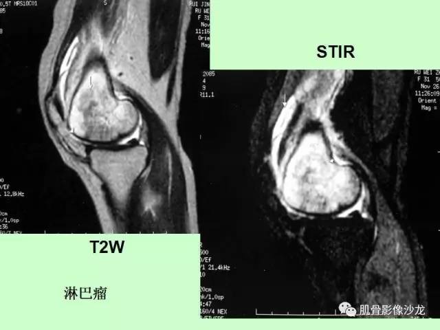 【PPT】骨骼肌肉系统疾病MRI诊断基础
