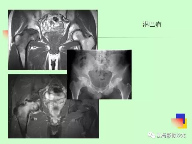 【PPT】骨骼肌肉系统疾病MRI诊断基础