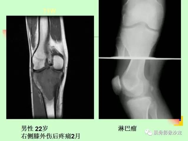 【PPT】骨骼肌肉系统疾病MRI诊断基础