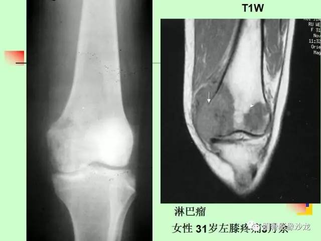 【PPT】骨骼肌肉系统疾病MRI诊断基础