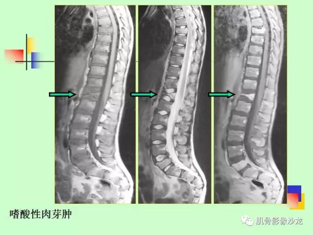 【PPT】骨骼肌肉系统疾病MRI诊断基础