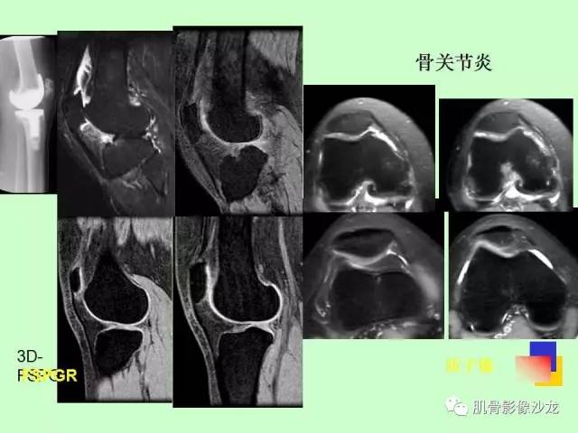 【PPT】骨骼肌肉系统疾病MRI诊断基础