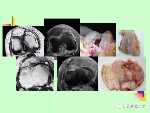 【PPT】骨骼肌肉系统疾病MRI诊断基础