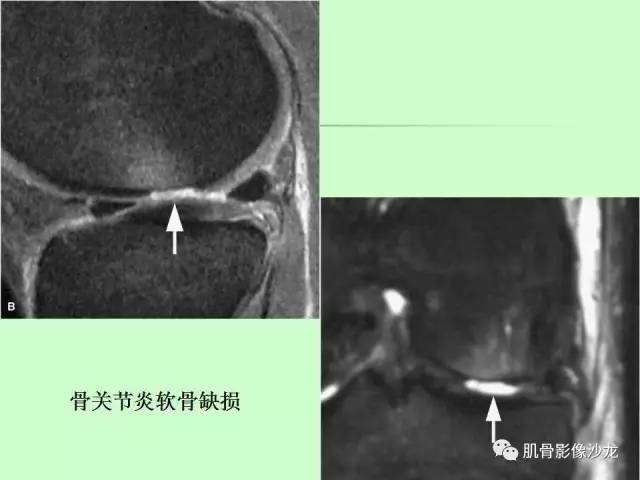 【PPT】骨骼肌肉系统疾病MRI诊断基础